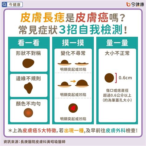 屁股長黑痣|皮膚長痣是皮膚癌嗎？醫教簡單3招自我檢測！